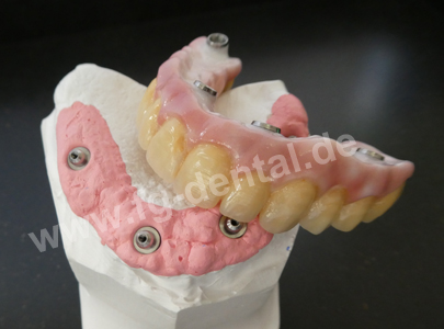 Zirkon, Implantat, Vollkeramik
